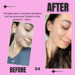 Voor- en na-foto's van huidverbetering na gebruik van LumiGlow masker.