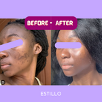 Voor- en na-foto's van vrouw na LumiGlow LED gezichtsbehandeling.
